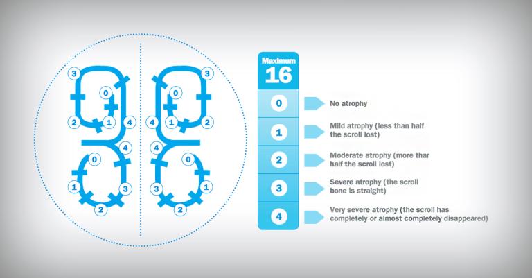 atrophic-rhinitis-diagnosis